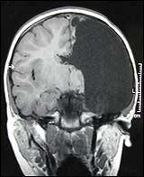 Picture of brain of Busra